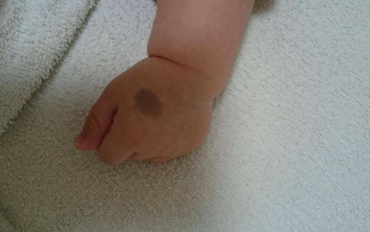 宝宝生下来屁股和脚淤青,宝宝生下来屁股青一大块