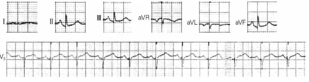 心电图qrs波群是什么意思,心电图中qrs电压怎么看