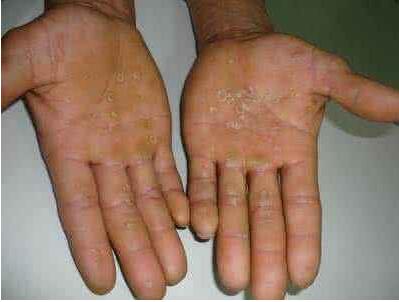 80岁老伯和26岁乖乖女都感染上梅毒，原因令人费解