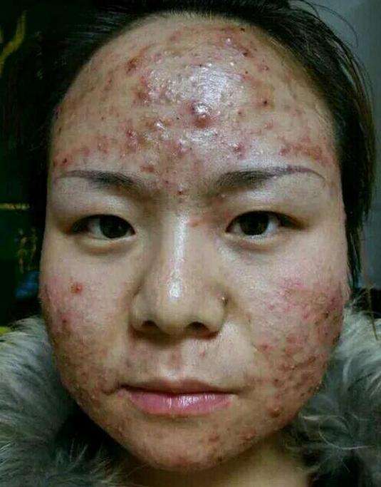 脸上长痘的位置分别代表什么,脸上不同部位长痘分别代表什么