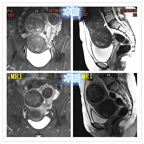 子宫肌瘤介入栓塞造影剂作用,子宫肌瘤介入栓塞有副作用吗