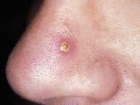 毛囊炎引起的疖肿有哪些症状,毛囊炎和疖肿的鉴别诊断