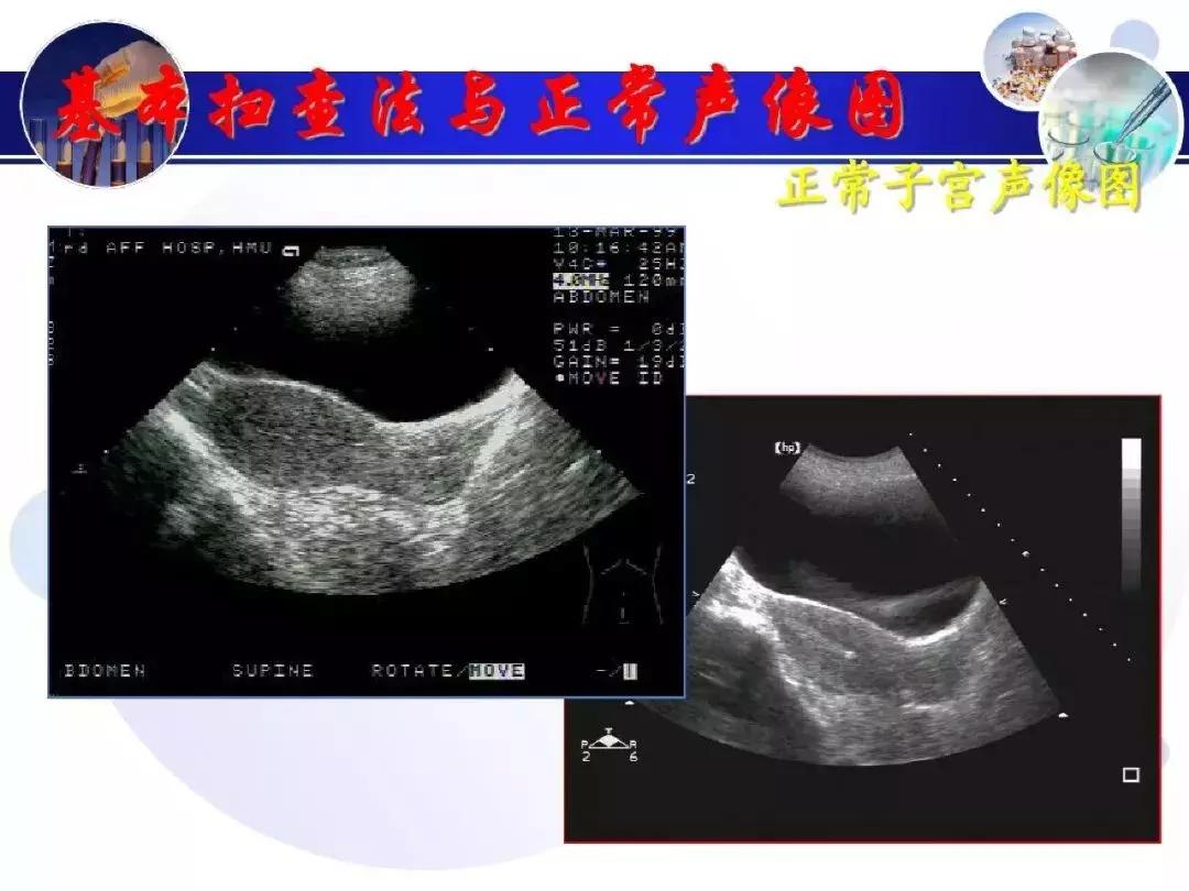 纯干货！子宫及附件解剖和超声诊断