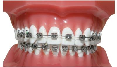 矫正牙齿用哪种牙套效果最好,网上买的矫正牙齿牙套有用吗