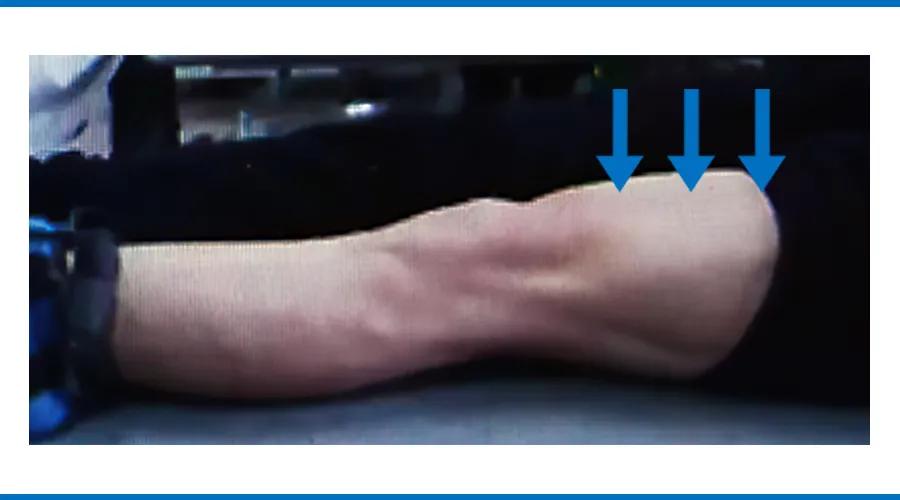 下雨天膝关节疼痛是怎么回事,下雨天膝关节肿大硬