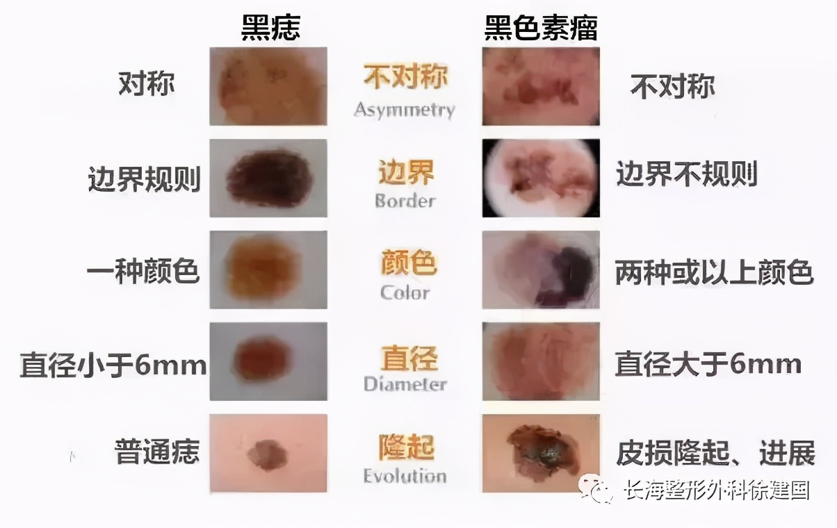 小痣好切还是大痣好切,有个痣是点痣好还是直接切掉好