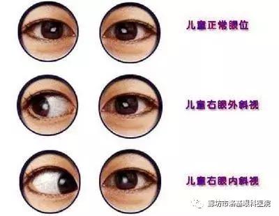 如何分辨斜视的眼睛,怎么分辨眼睛有没有斜视