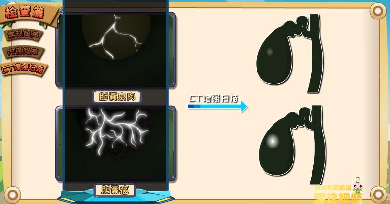 怎么样区分胆囊息肉和胆囊癌,胆囊息肉真假鉴别