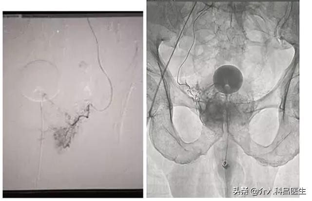 301医院前列腺增生介入治疗案例,介入栓塞治疗前列腺增生靠谱吗