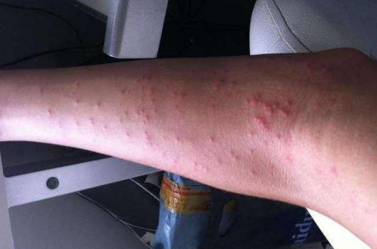 麻黄葛根汤治疗麻疹,麻黄连翘赤小豆治麻疹