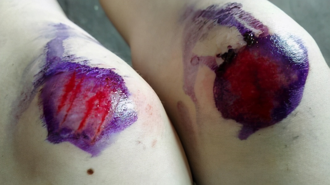 烫伤起大水泡涂烫伤药有用吗,烫伤后该涂抹什么偏方