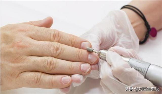 灰指甲怎么治好得最快小妙招,灰指甲怎么治才能彻底根除