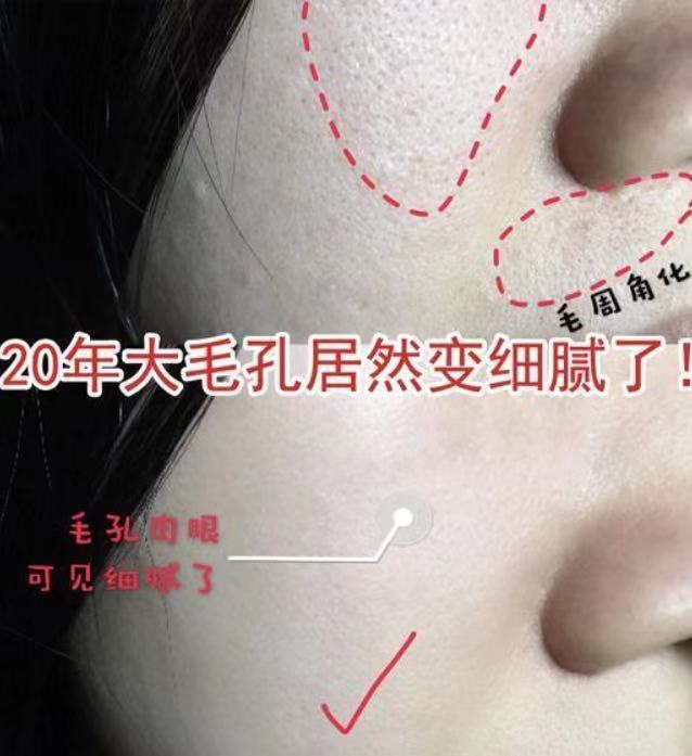 王鸥谈打了瘦脸针,王鸥打过瘦脸针吗