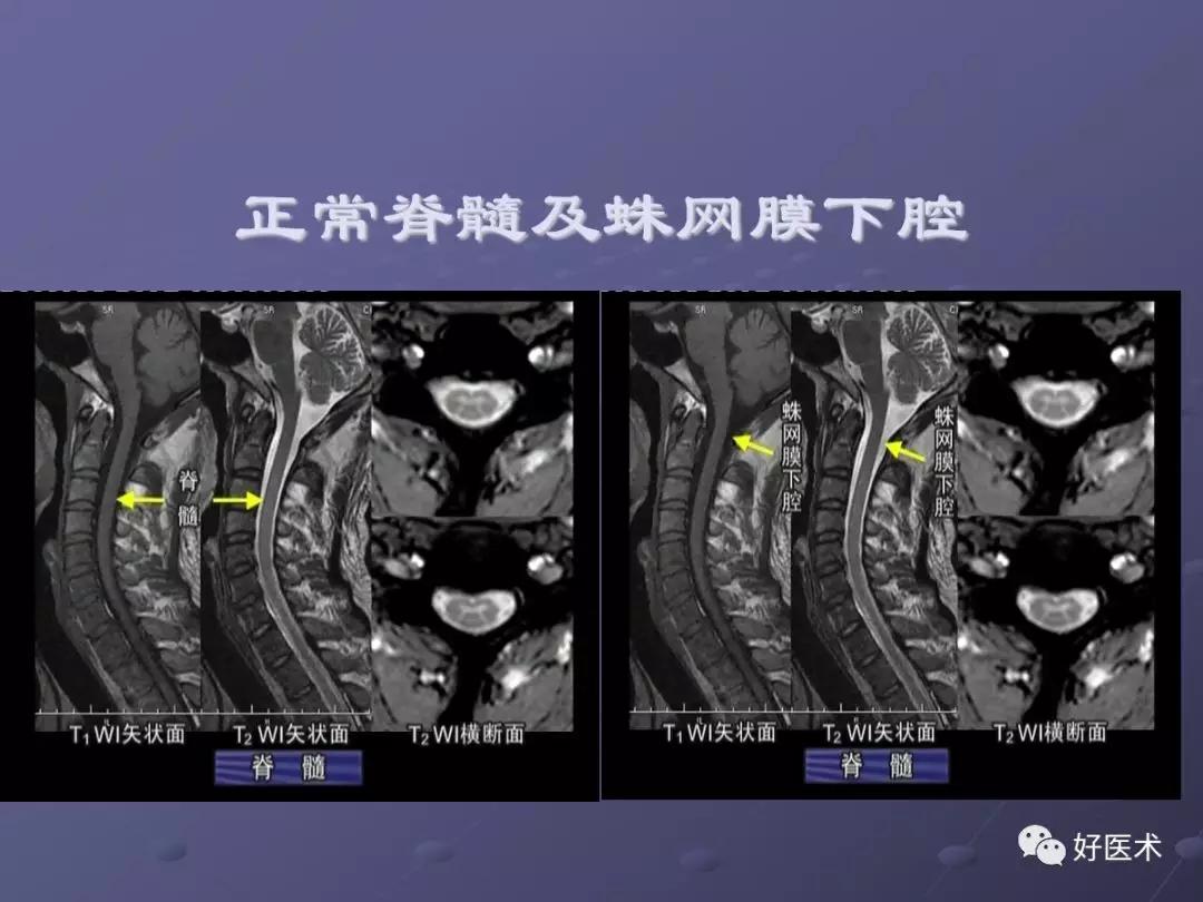 脊柱mri有哪些特点,乳腺疾病的mri诊断及鉴别