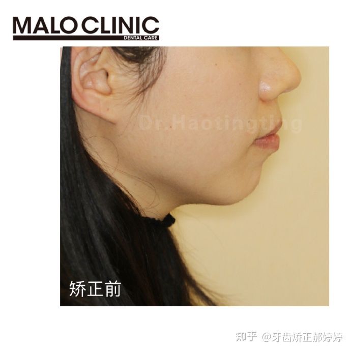 上海成人牙齿矫正失败案例,上海牙齿矫正郝婷婷医生