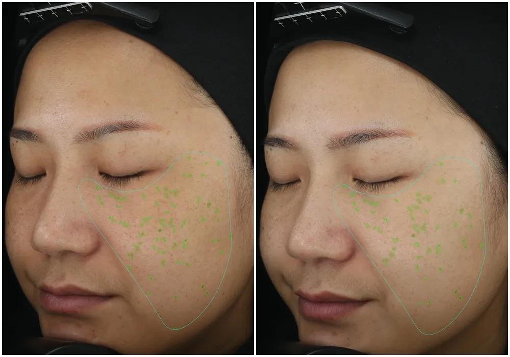 瞬间让脸变白的神器,让斑快速消失