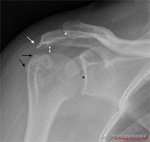 肩颈椎疼怎么办最快最有效,颈椎肩周痛有什么办法解决