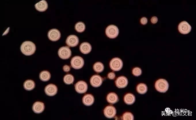 艾滋病患者最易发生的4种真菌感染，其中两种致命性非常高