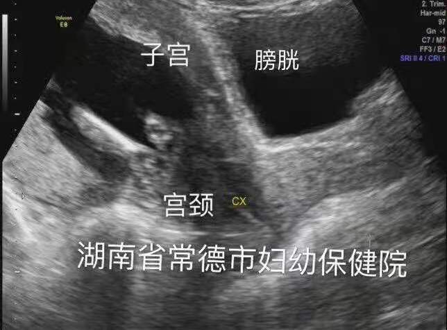 孕妇突发排尿困难，市妇幼专家：警惕“子宫箝闭”引起的尿潴留