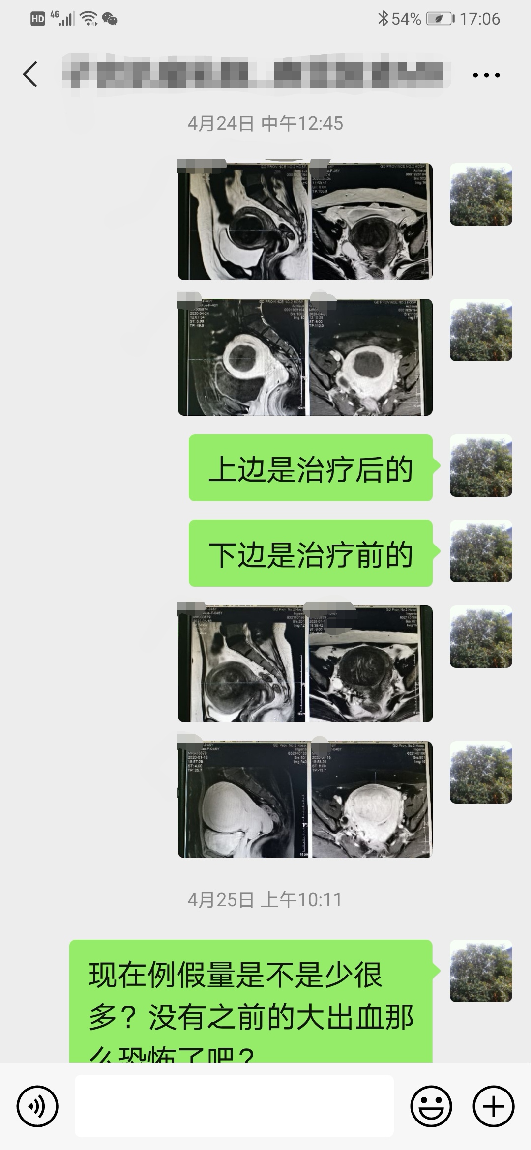 子宫肌瘤微创后月经量大有血块,严重贫血子宫肌瘤手术风险大不大