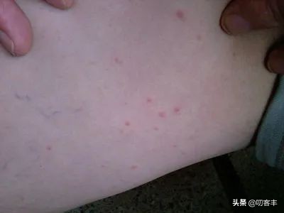 什么是风疹幼儿,什么是风疹