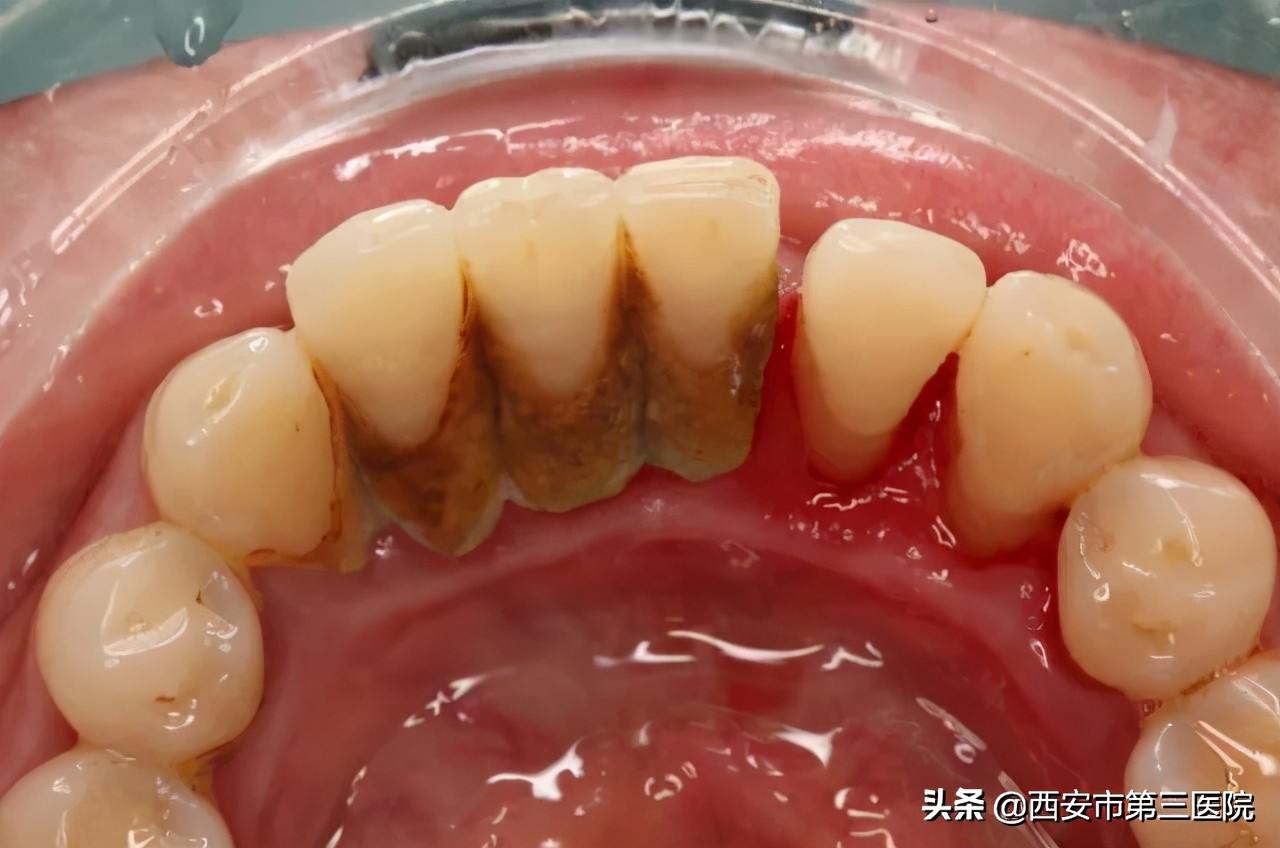 北大口腔洗牙收费标准,南京口腔医院洗牙流程