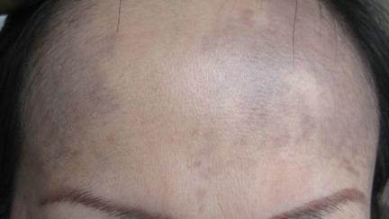 长斑了要怎么调理呢,长斑了该怎么办该用什么护肤品