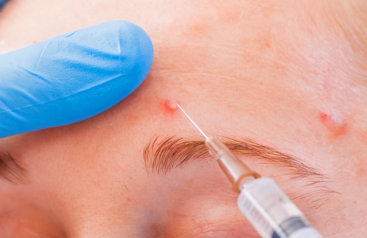 痘痘反反复复出现?预防复发,只要做好这4点