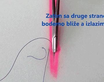 常用的手术缝合方法图,临床常见常用伤口缝合方法