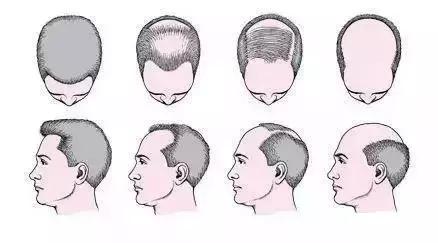 两侧头发后移怎么办,天生额角两侧没有头发怎么办