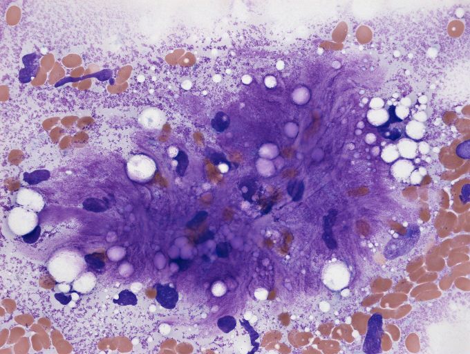 脂肪肉瘤和脂肪瘤怎么分辨,脂肪瘤很常见吗