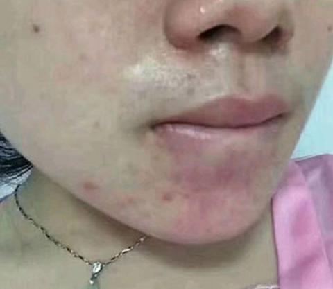 皇家雨燕教你痘痘肌の正确保养方式