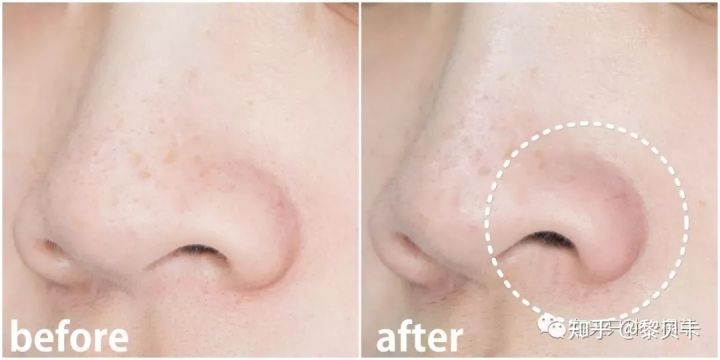 黑头去除神器排行榜,黑头粉刺清除强力推荐网红产品