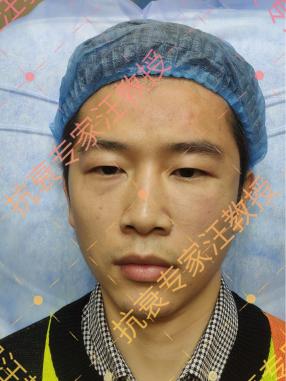 眼袋泪沟怎么消除学生,眼袋泪沟怎么消除视频教程