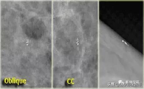 乳腺钙化怎么区分良性和恶性,乳腺钙化的诊断与分级