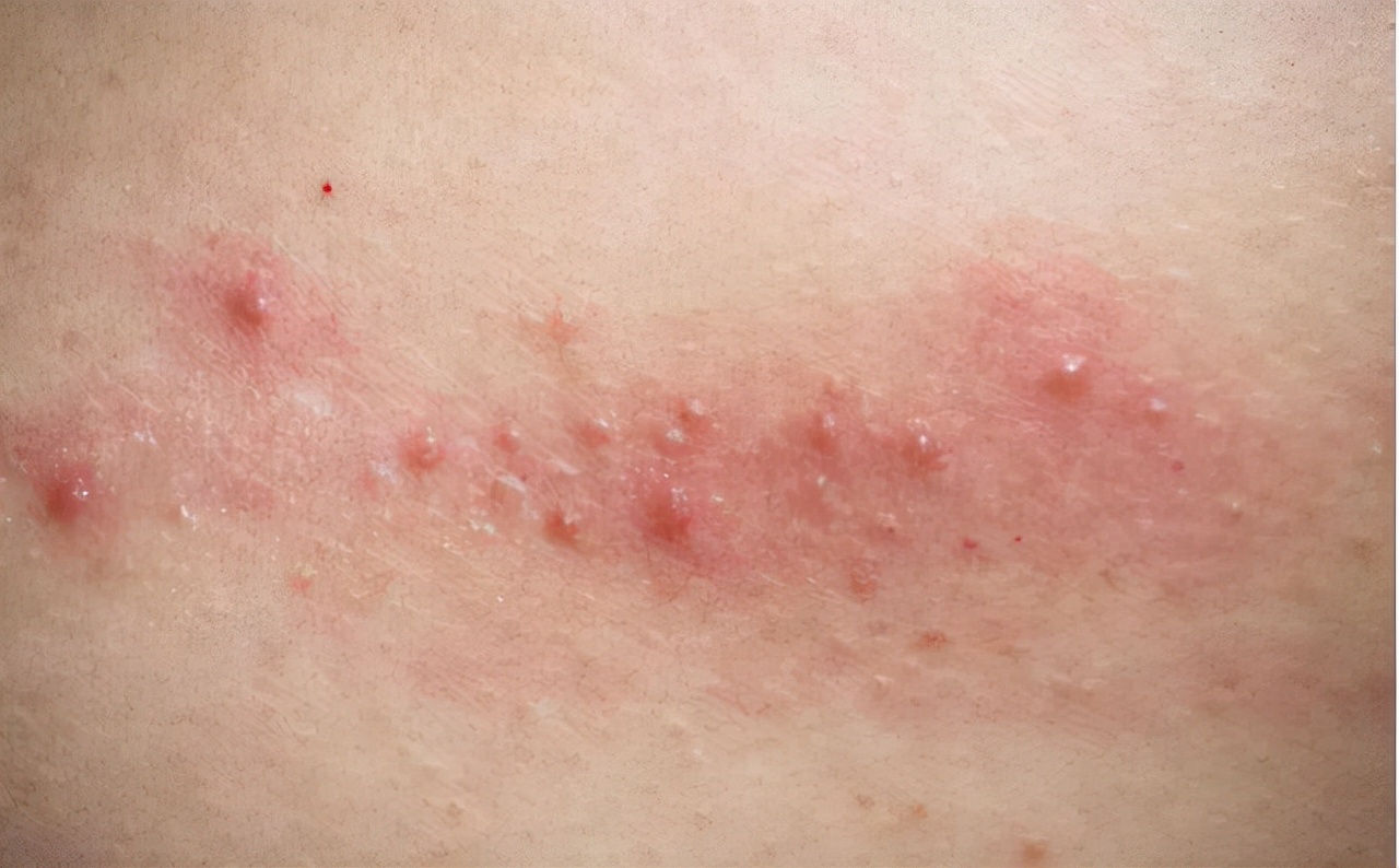 艾滋病期有皮肤长小白泡点症状,艾滋病的皮肤疱疹症状会不会痒