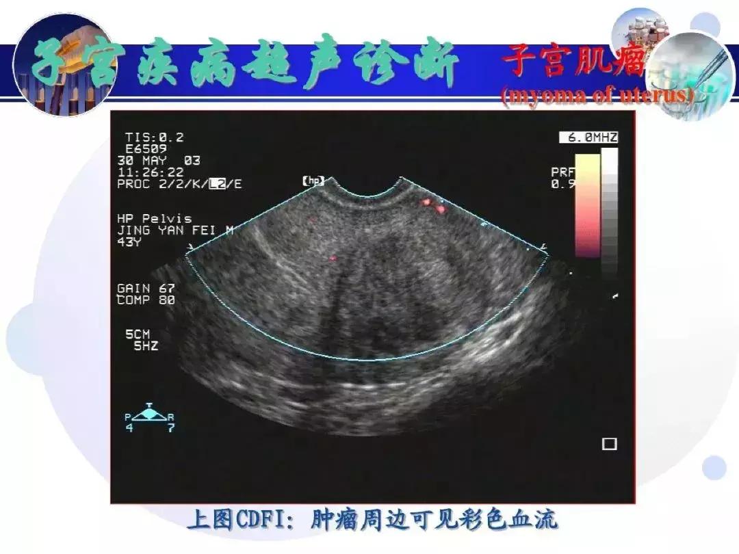纯干货！子宫及附件解剖和超声诊断