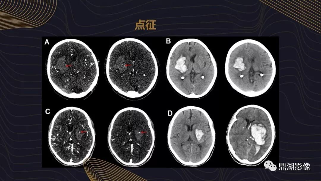 不简单|脑出血超详细学习笔记
