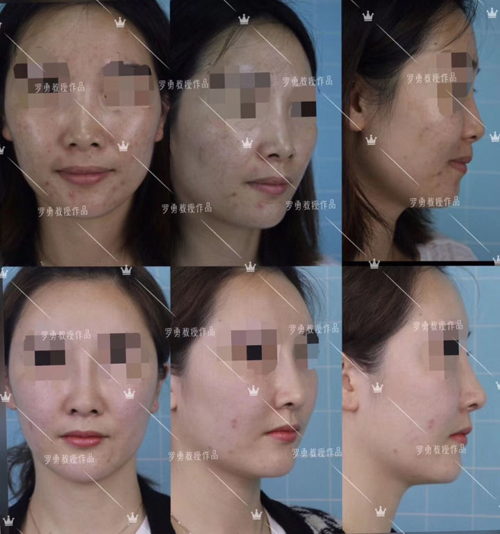 鼻骨过宽怎么改善,鼻骨过宽怎么化妆