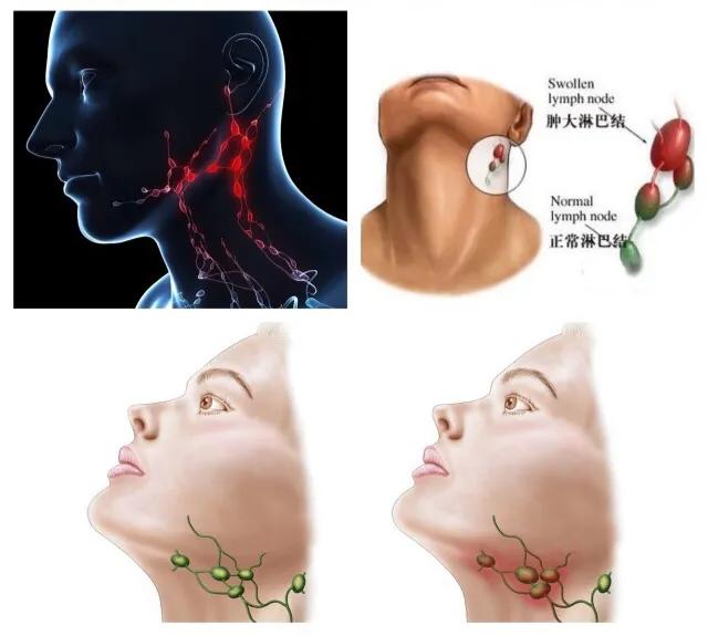 颈部淋巴结肿大恶性彩超报告单,颈部淋巴结肿大恶性会危及生命吗