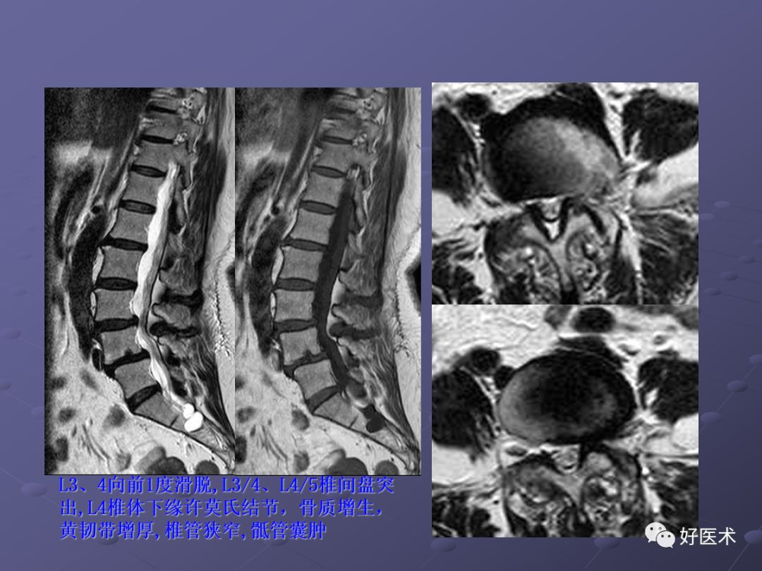 脊柱mri有哪些特点,乳腺疾病的mri诊断及鉴别
