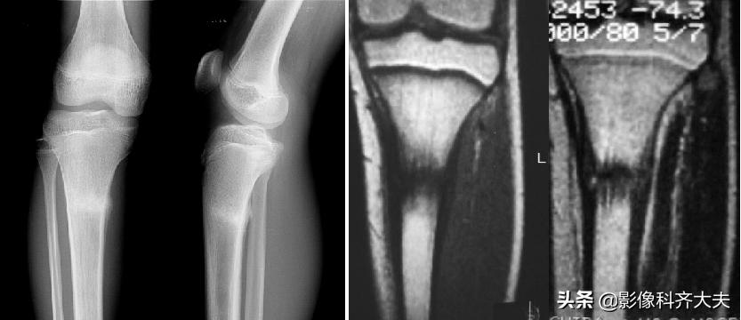 骨折的影像学检查及各自的优势,骨折的影像学愈合标准