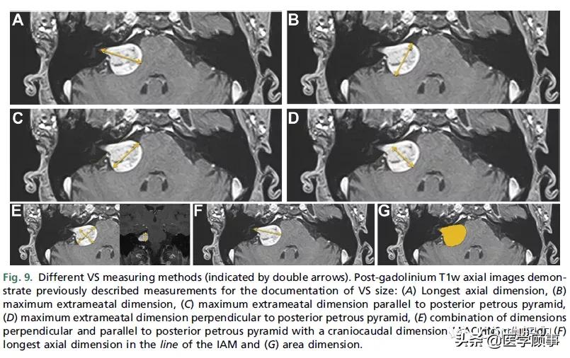 「综述」前庭神经鞘瘤的成像：诊断、监测、和治疗计划