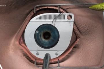 手术的时候医生对你做了什么,手术时切了一片肺叶