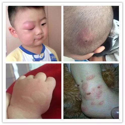 蚊子咬很痒用什么止痒效果好,宝宝被蚊子咬了用什么止痒好得快