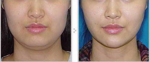 每个月花1000化妆品比不上医美吗？整形医生告诉你事实真相