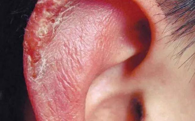 民间治冻疮的最好方法,老中医妙方萝卜加陈皮治冻疮