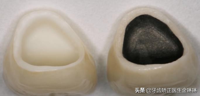 现在最好的烤瓷牙材料,做的烤瓷牙有点黄怎么补救