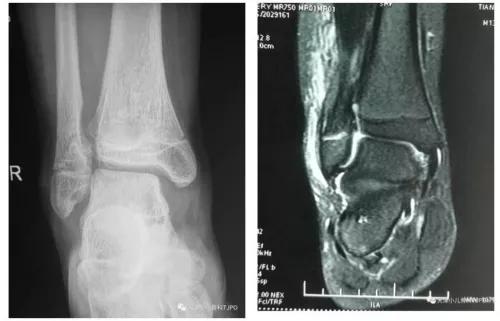 小孩手摔骨折打石膏后可以动吗,摔倒脚骨折需要打石膏吗