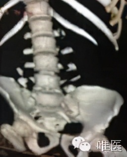 腰椎压缩性骨折保守治疗畸形愈合,骨折或关节脱位的急救处理